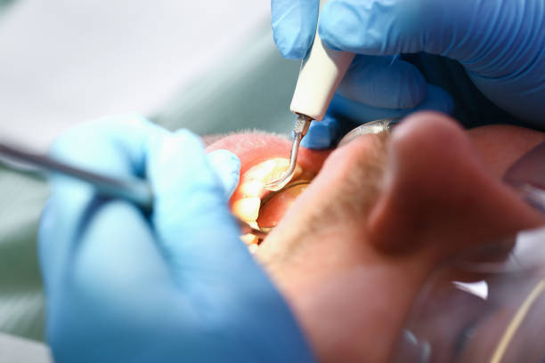 Best Urgent Care for Lost Fillings or Crowns in Centerville, OH