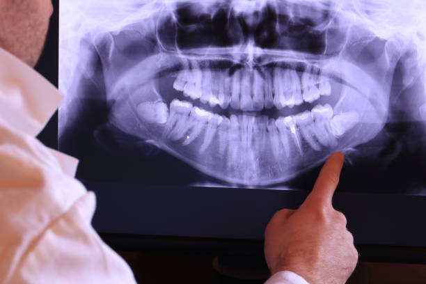 Best Emergency Tooth Extraction in Centerville, OH