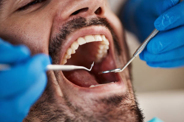 Best Emergency Dental Care for Broken or Chipped Teeth in Centerville, OH